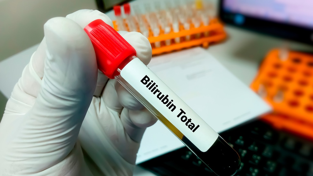 Bilirrubina Total