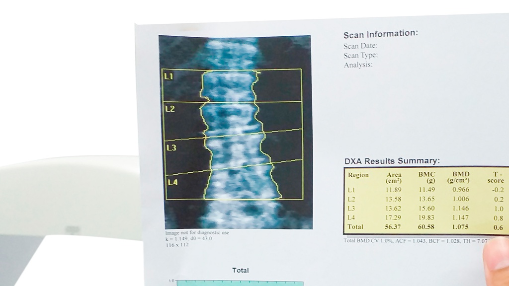 Densitometría de Columna Lumbar