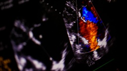 [USDCES] Ultrasonido Doppler Color Endo. Seg. Folicular